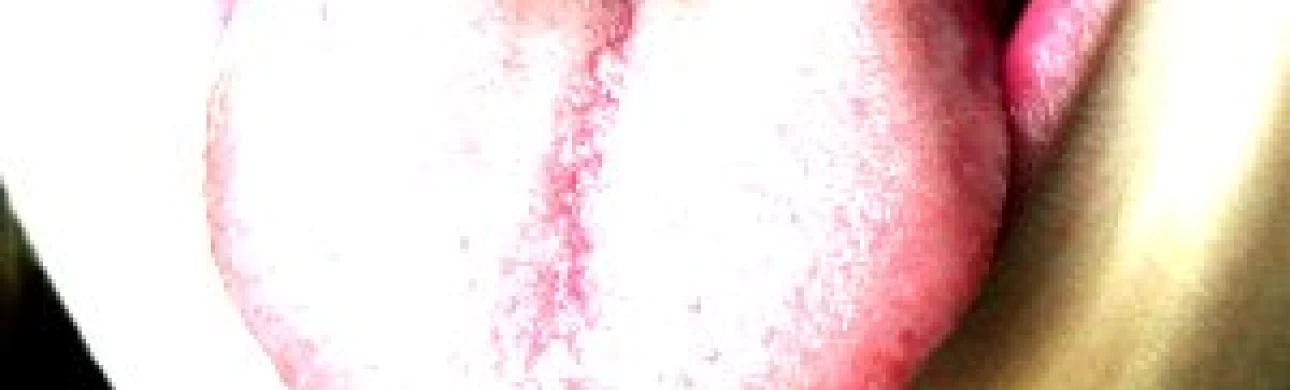 Sublingvální imunoterapie je při léčbě pylové alergie výhodná