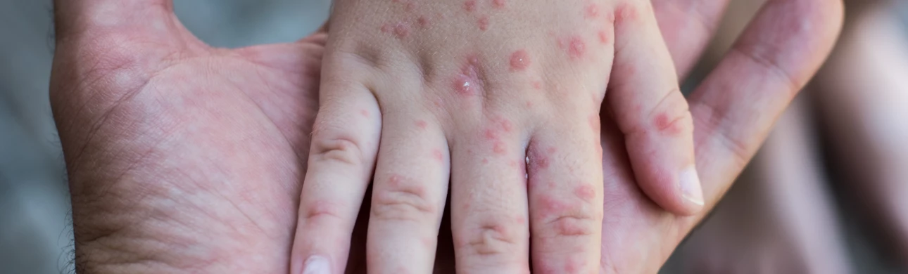 Nejčastější projevy alergií během dětského i dospělého věku