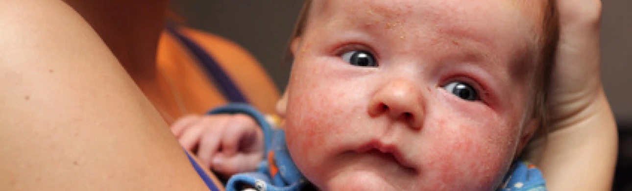 Průběh atopického ekzému je určován geneticky