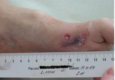 Pětidílný videoseriál o vyšetření diabetické nohy