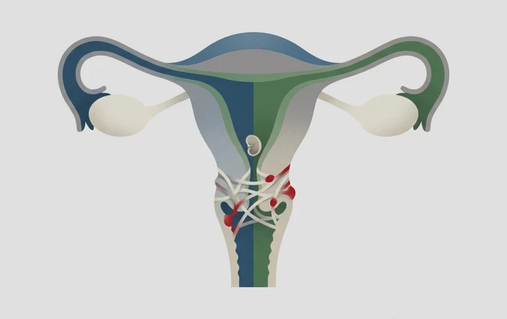 Endometrióza ženám může bránit v otěhotnění